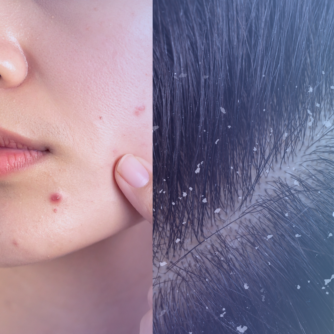Neem + Tea Tree for Acne & Dandruff - SECRET TATTVA