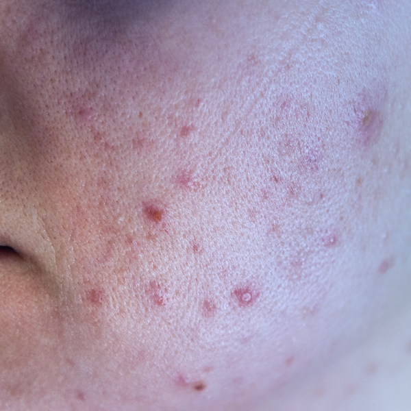 Hemp Seed Oil — Skin Barrier Repair & Acne Care