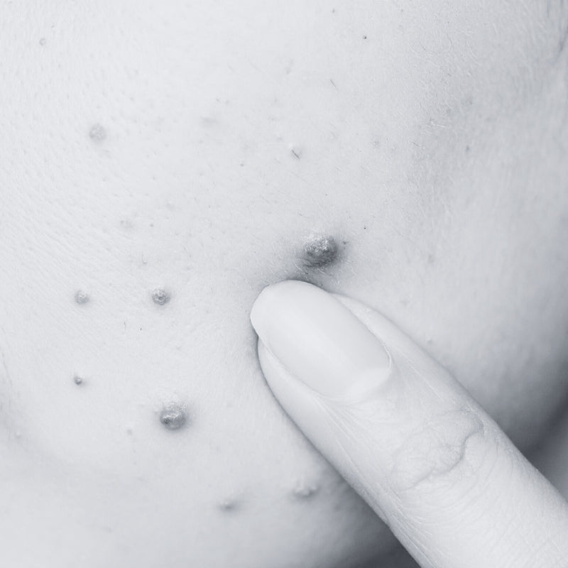 ACNE PRONE SKIN - SECRET TATTVA
