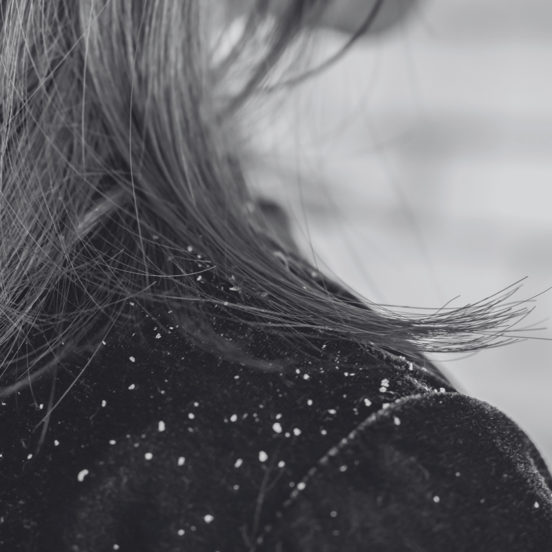 DANDRUFF - SECRET TATTVA