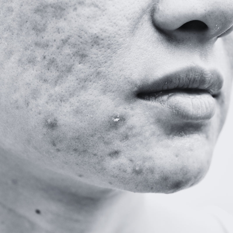 FACE SCAR /POST ACNE SCARS - SECRET TATTVA