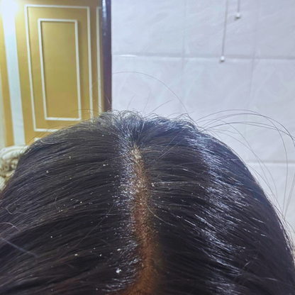 Dandruff (Oily Scalp) Combo