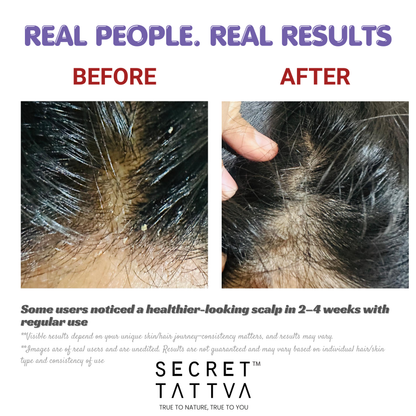 Dandruff Combo for Healthy Scalp - SECRET TATTVA