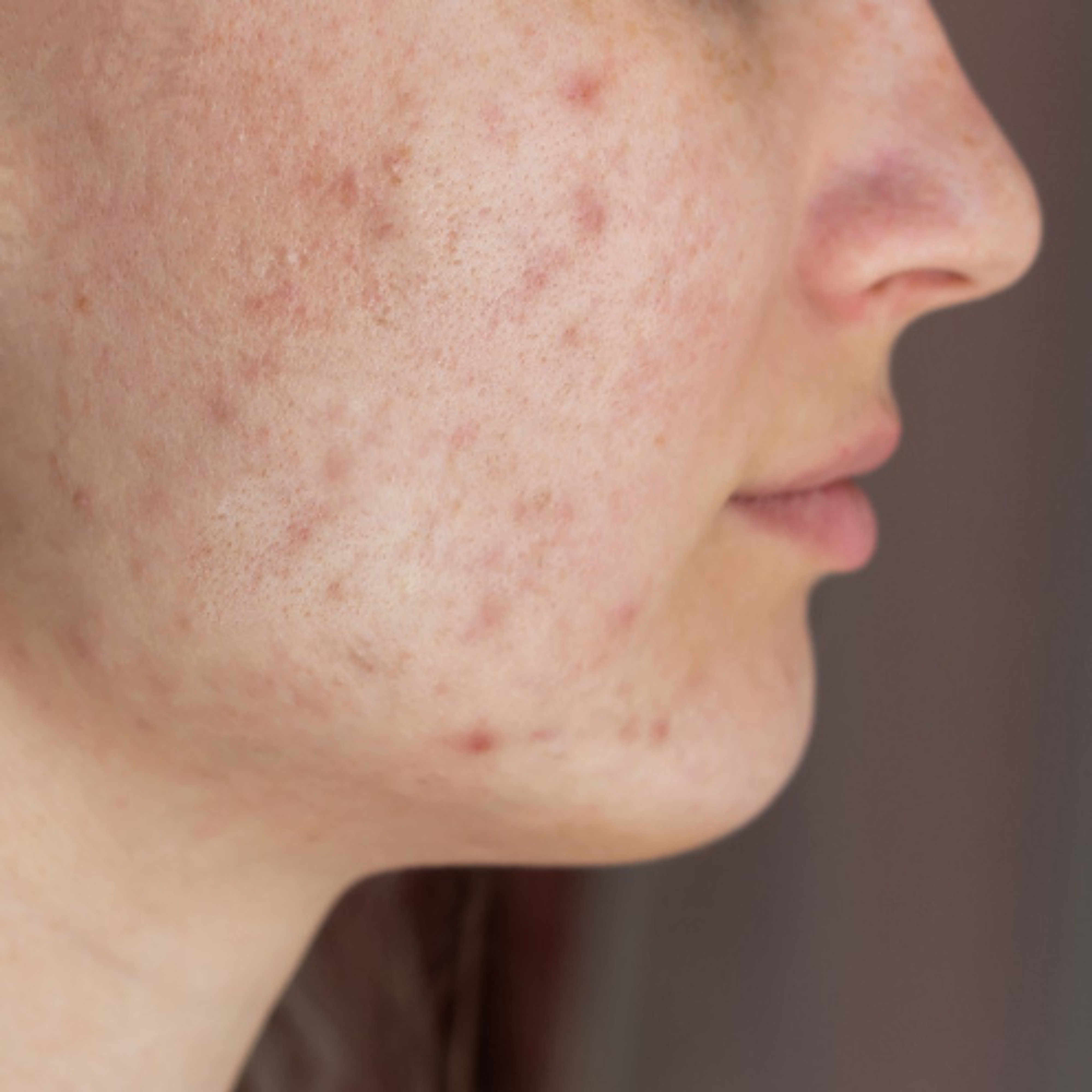 Face scars (Acne Scars)