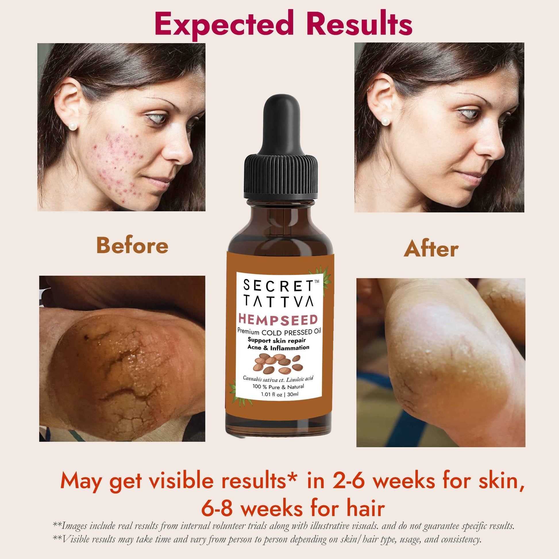 Hempseed Oil for Skin Barrier Repair & Redness