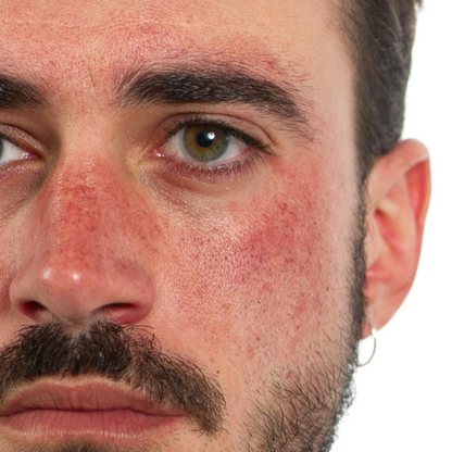 Inflammation/ Redness Combo