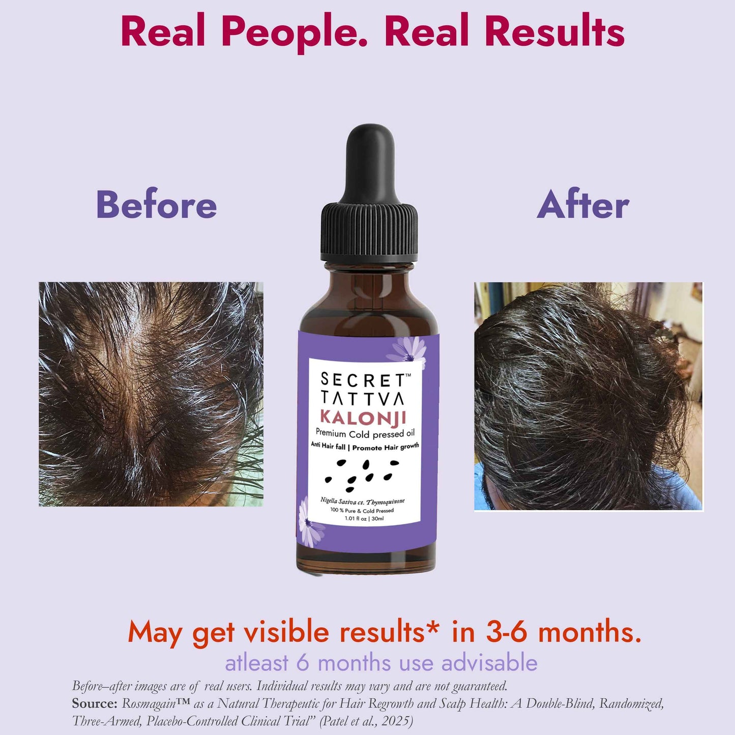 Kalonji Oil for Hair Growth, Premature Greying and Scalp Health