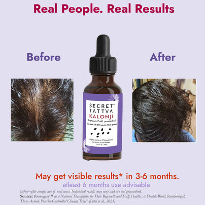 Kalonji Oil for Hair Growth, Premature Greying and Scalp Health