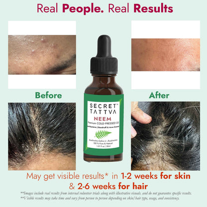 Neem Cold Pressed Oil for Acne & Dandruff