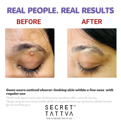 Regular Acne Combo - SECRET TATTVA
