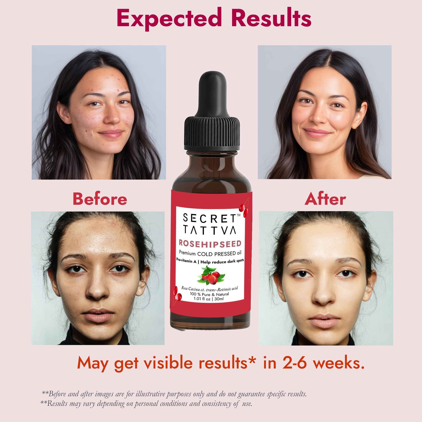 Rosehipseed Oil for Dark Spots, Pigmentation & Wrinkles