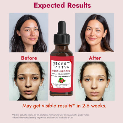 Rosehipseed Oil for Dark Spots, Pigmentation & Wrinkles