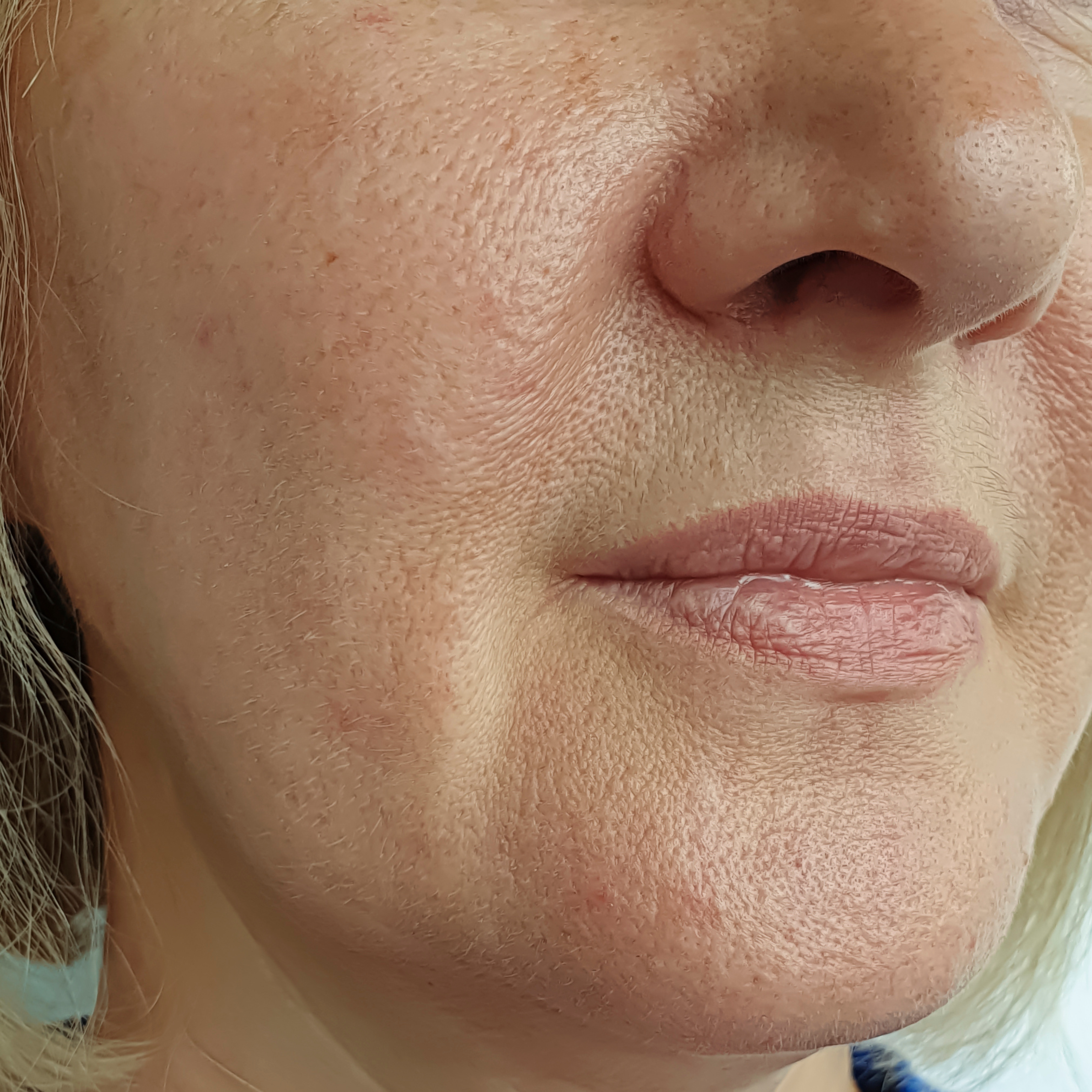 Skin Tone Uplift(Oily Skin)