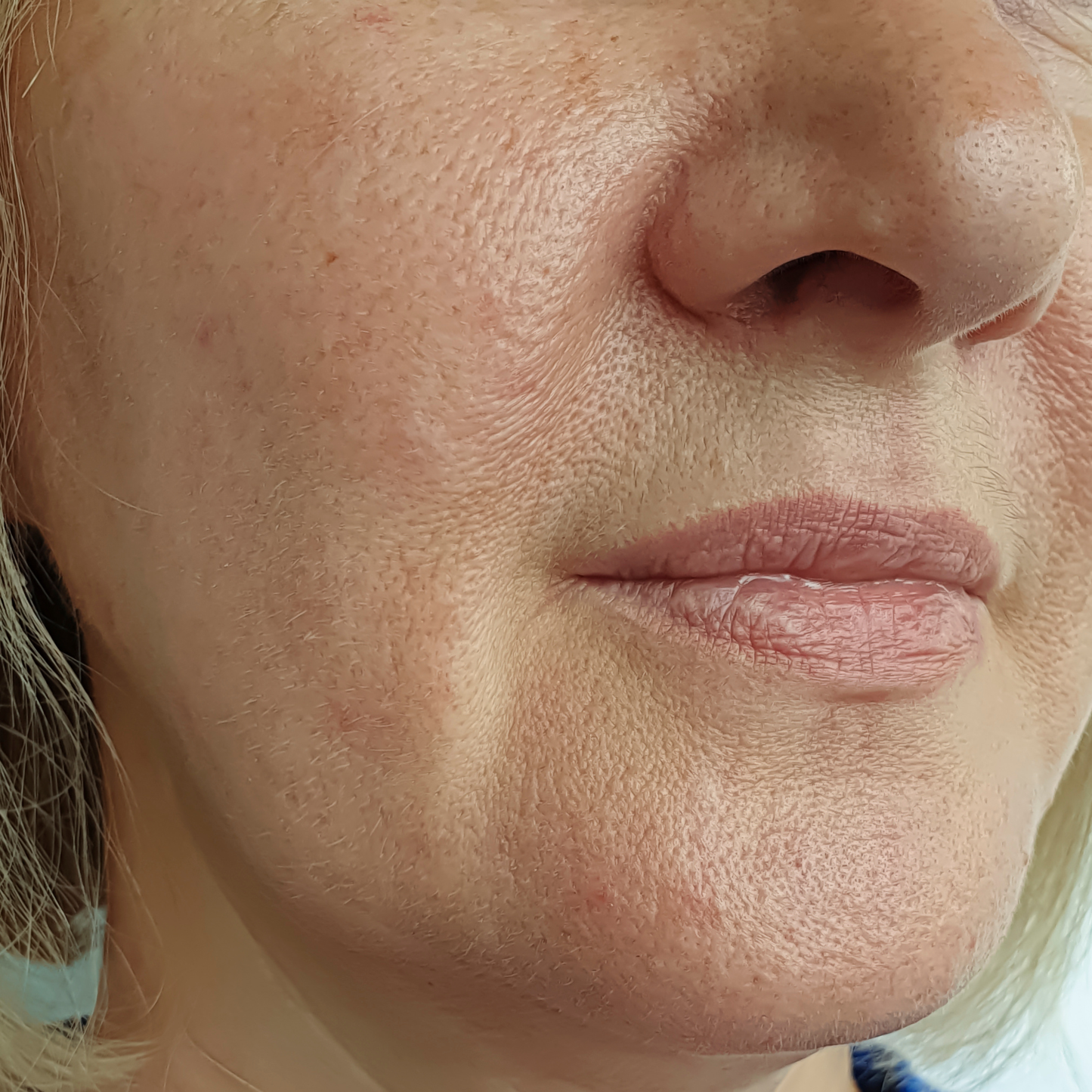 Skin Tone Uplift(Oily Skin)