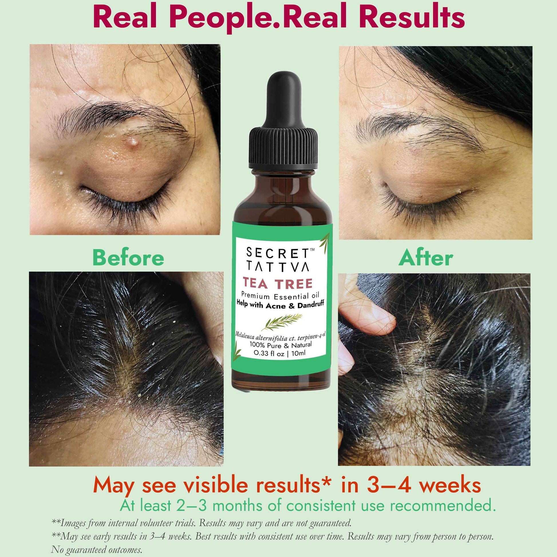 Tea Tree Oil for Acne & Dandruff
