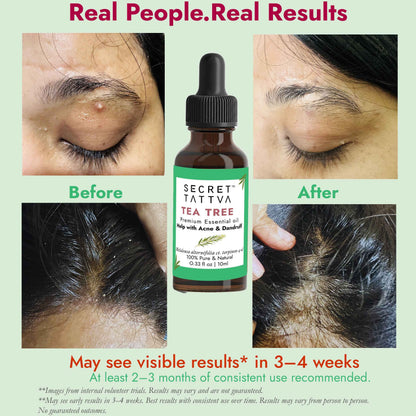 Tea Tree Oil for Acne & Dandruff